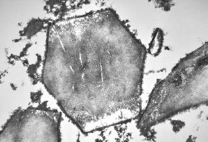 M, | crystalline inclusions in plasmocyte M, | crystalline inclusions in plasmocyte